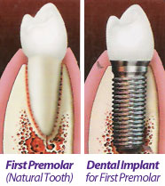implant-04 Dental-Implants-Tampa