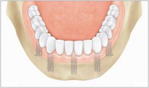 prosthesis1 Implant-DENTURES