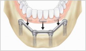 prosthesis2 Removable-Dentures