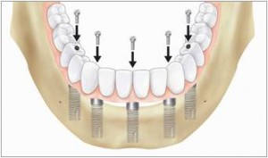 prosthesis3 Fixed-Dentures
