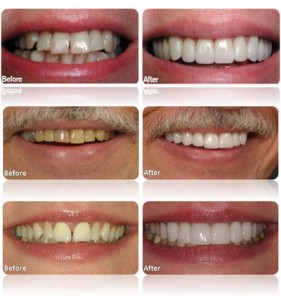 Veneers-South-Tampa-Cosmetic-Dentist