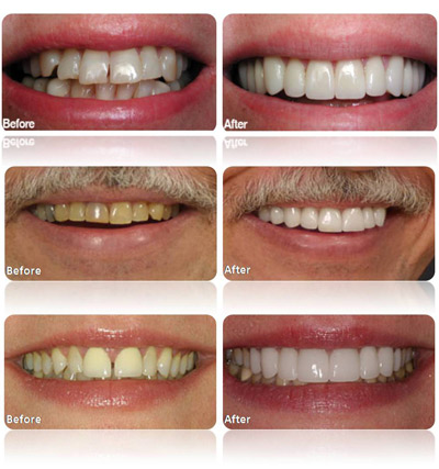 Veneers-South-Tampa-Cosmetic-Dentist
